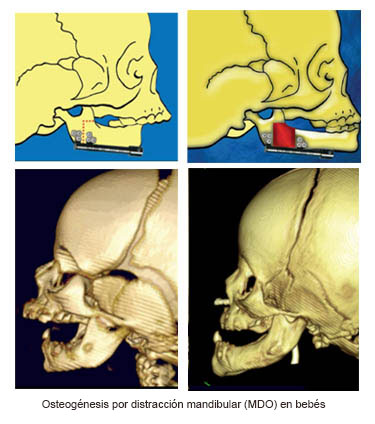 https://candylicio.store/SiteCollectionImages/Infant_Mandibular_Distraction_Osteogenesis_es.jpg