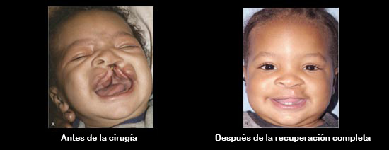 https://candylicio.store/SiteCollectionImagesArticleImages/CleftbeforeAfter_Baby_es.jpg