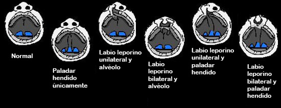 https://candylicio.store/SiteCollectionImagesArticleImages/CleftlippalateABCDEF_es.jpg