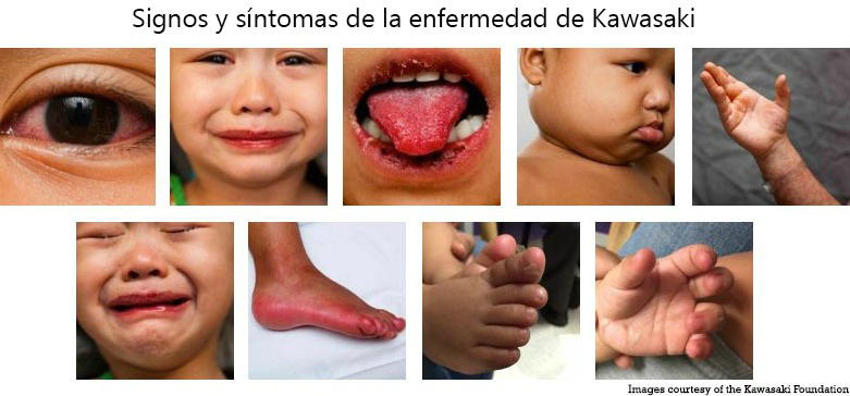 https://candylicio.store/SiteCollectionImagesArticleImages/Signs_Symptoms_Kawasaki_Disease_es.jpg