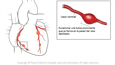 https://candylicio.store/SiteCollectionImagesArticleImages/aneurysm_texaschildrens_es.jpg