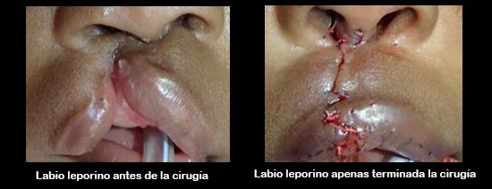 https://candylicio.store/SiteCollectionImagesArticleImages/cleftLipBeforeAfter2_es.jpg